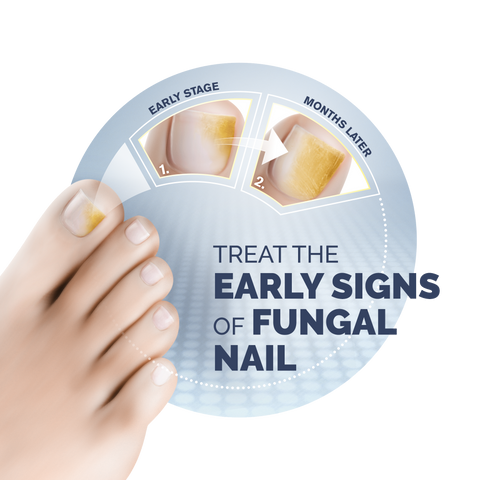 Toenail fungus takes time to fix | UCLA Health